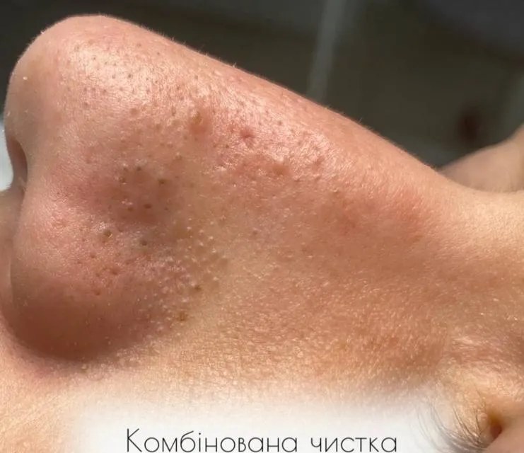 До чистки обличчя