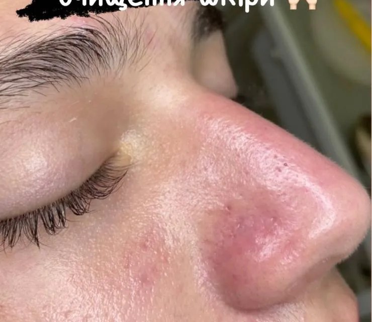 Після чистки обличчя в МаКо