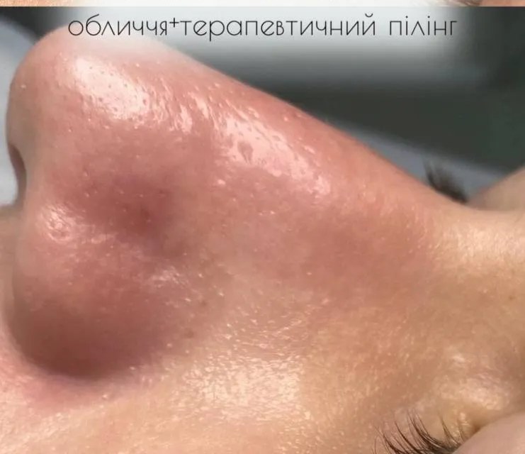 Після чистки обличчя в МаКо