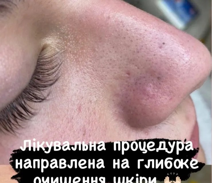 До чистки обличчя